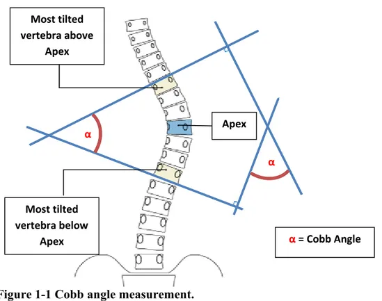 Figure 1-1 Cobb angle measurement. 