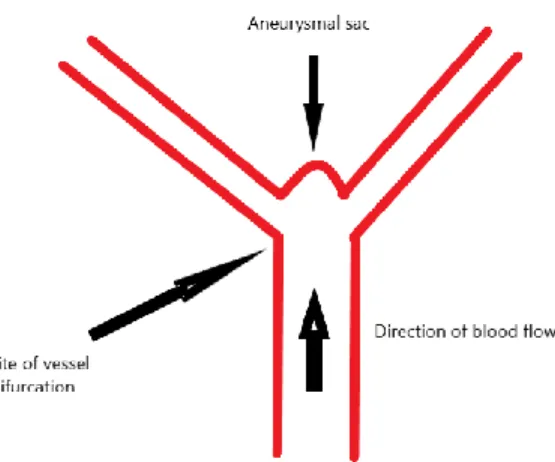 Figure 1 What is an aneurysm? 