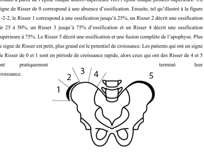 Figure 1-2-2. Illustration de la mesure du signe de Risser.   Le cartilage triradié 