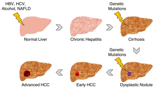 Figure  2.4  Schematic  representation  of  HCC’s  natural  history.  HBV  =  hepatitis  B 