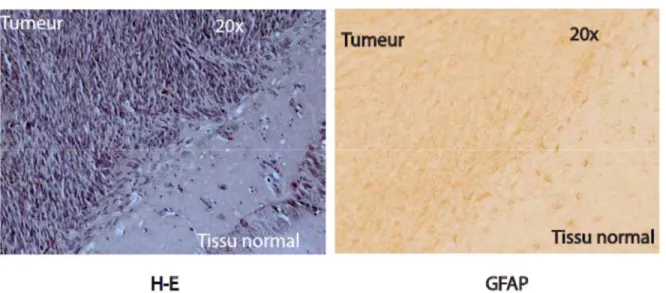 Figure 12. Formation du glioblastome dans le cerveau de souris à partir des cellules souches  cancéreuses du GBM humain