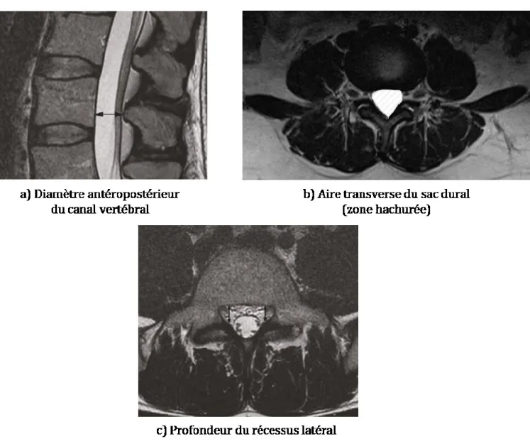 Figure 1.8 Mesures utilisées pour déterminer la présence d’une sténose lombaire  centrale et d’une sténose du processus latéral 