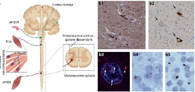 Figure  1.3  Dégénérescence  des  neurones  moteurs,  inclusions  et  agrégats  cytoplasmiques  dans  la  SLA