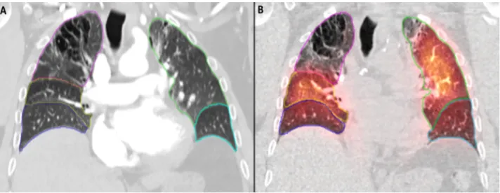 Figure 1- Manual segmentation of lung lobes on DECT and SPECT/CT 