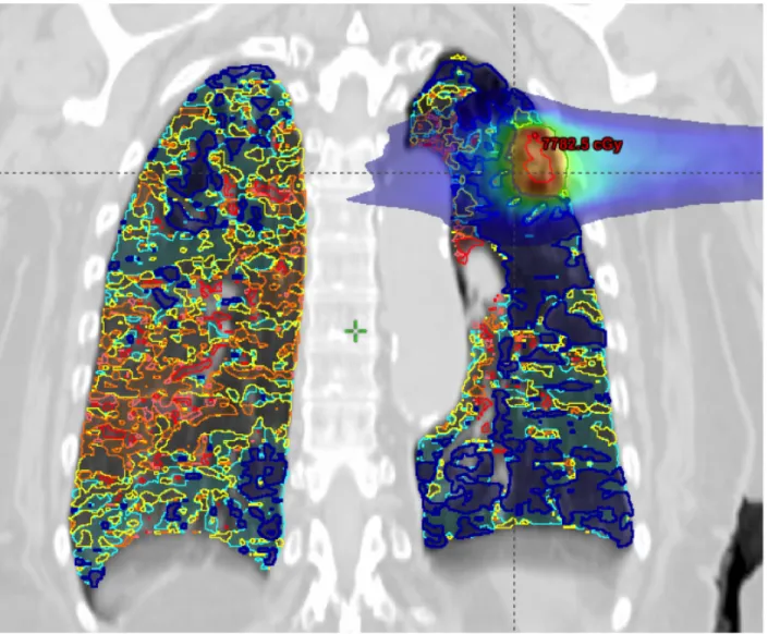 Figure  2-  Coronal  slice  showing  6  functional  lung  sub-volumes  with  increasing  iodine  content