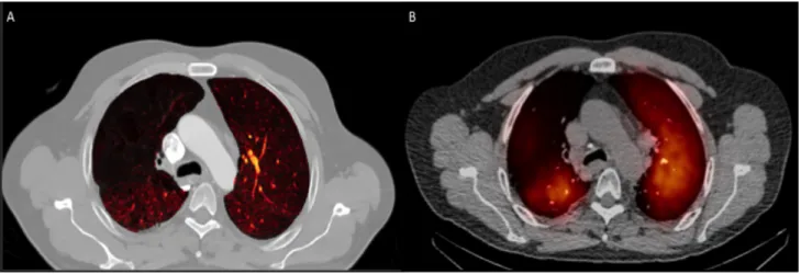 Figure 3- DECT-iodine and SPECT/CT maps 