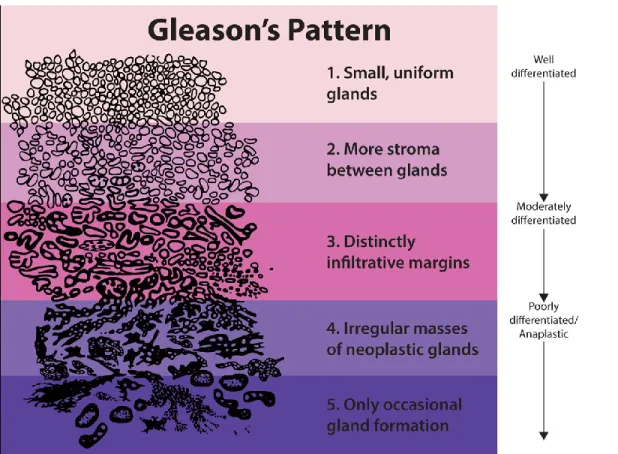 Figure 2.  Représentation des différents patrons de grades de Gleason. On recommande 