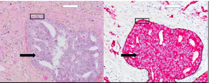 Figure 7.  Carcinome intracanalaire de la prostate (IDC-P). À gauche, (coloration HPS, 