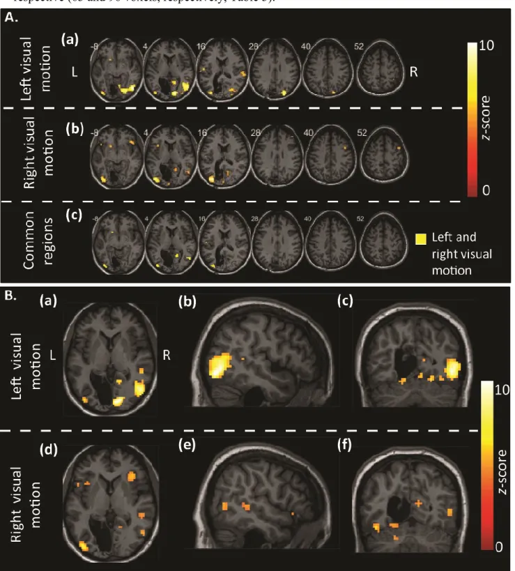 Figure 5.  Patient cortical blood oxygen level dependent (BOLD) activations in the whole  brain sequence scan
