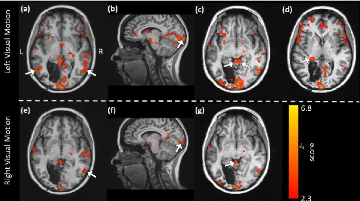 Fig. 5 shows BOLD activation maps resulting from the midbrain analysis and estimated for left  and right visual motion conditions contrasted with static stimuli