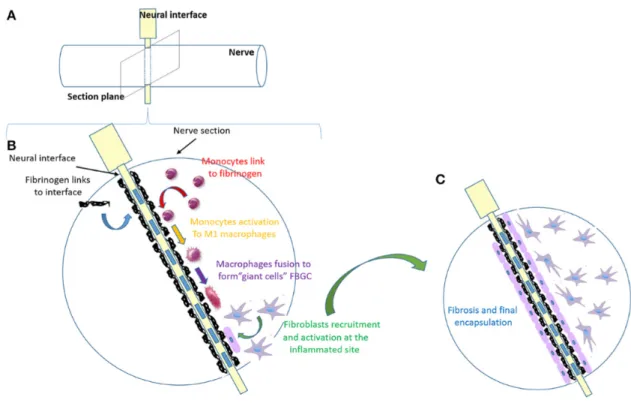 Figure 4.  Étapes de la réaction à corps étrangers dans le contexte d’implants  neuronaux 