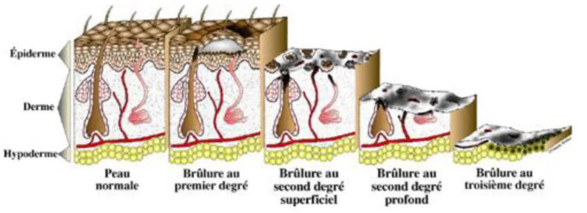 Figure 1. Les degrés de brûlures 
