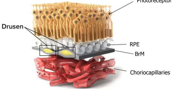 Figure 8: Dry AMD is recognized with drusen hallmark 