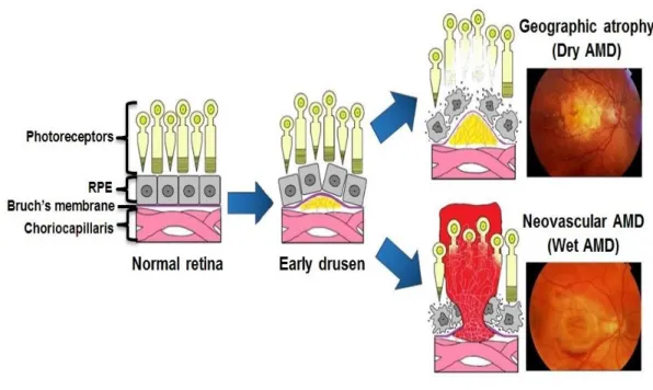 Figure 9: Pathogenesis milestones in AMD progression 
