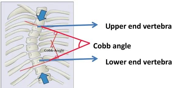 Figure  4:  The  Cobb  angle  used  for  measurement  of  the  degree  of  curvature  of  the  spine  (adapted from https://www.coreconcepts.com.sg/article/cobb-angle-and-scoliosis)