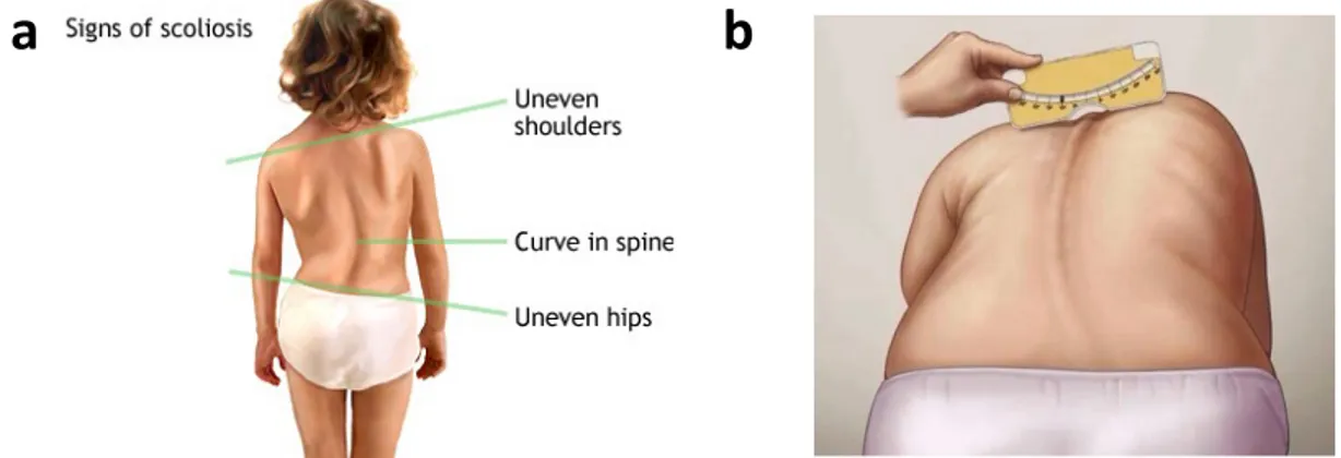Figure 6: a. Signs of Scoliosis b. Adam’s forward bending test using a scoliometer for  measuring the trunk deformity (http://umm.edu/health/medical/reports/articles/scoliosis),   (https://www.pinterest.com/ottawascoliosis/school-screening-for-scoliosis-wh