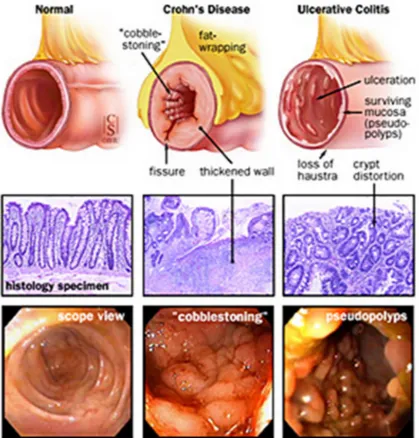Figure 6.  Apparence de la muqueuse intestinale chez les personnes saines,  atteintes de la MC et de la CU