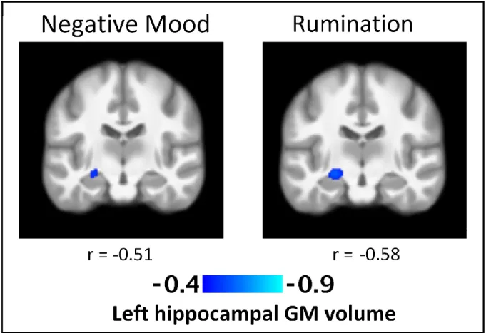 Figure 1. T-Statistic maps of the negative association between regional left hippocampal gray 