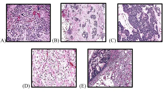 Figure 4.  Hematoxilin  &amp;  eosin  staining  of  different  histological  types  of  epithelial  ovarian  cancer