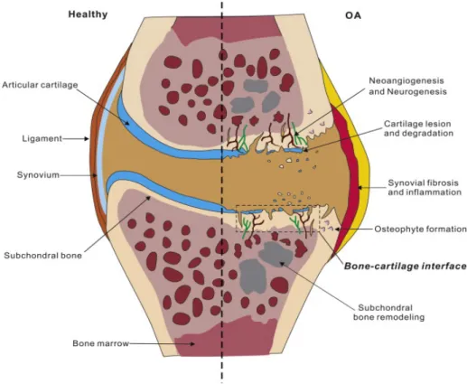 Figure 1 : L’évolution de l'arthrose. Différence entre l'articulation normale et  arthrosique