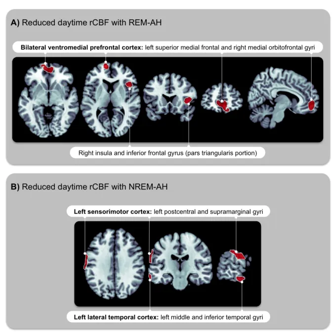 Figure 1. Daytime brain hypoperfusion patterns associated with OSA during REM versus NREM sleep