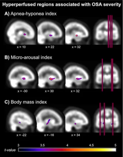 Figure 3. Locations of hyperperfusions that correlated with variables representing more severe obstructive sleep 