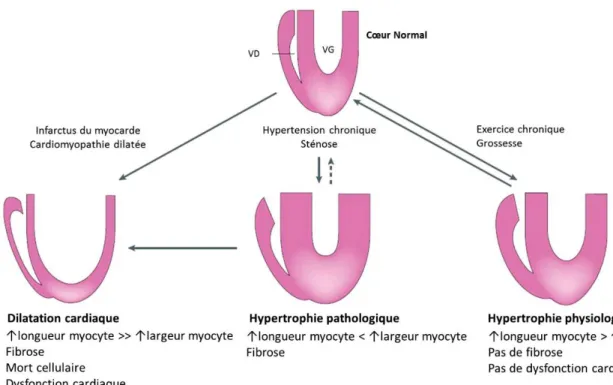Figure 1.1. Différents types d’hypertrophie cardiaque. Des stimuli comme l’hypertension ou  la sténose induisent à long-terme une hypertrophie pathologique du cœur caractérisée par une  augmentation de la longueur des myocytes supérieure à l’augmentation d