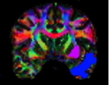 Figure 6: ROIs Used to Reconstruct the Left Uncinate Fasciculus 