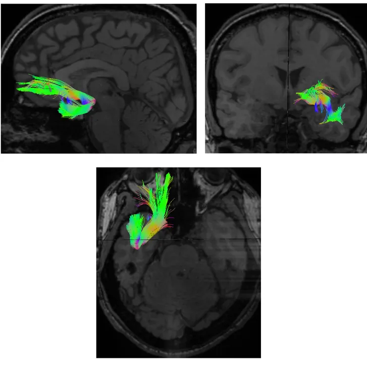 Figure 7: Left Uncinate Fasciculus Reconstruction 