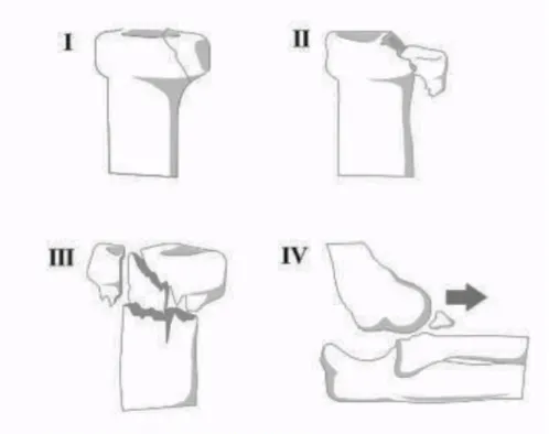 Figure 3: Schématisation de la classification de Mason-Johnston. 