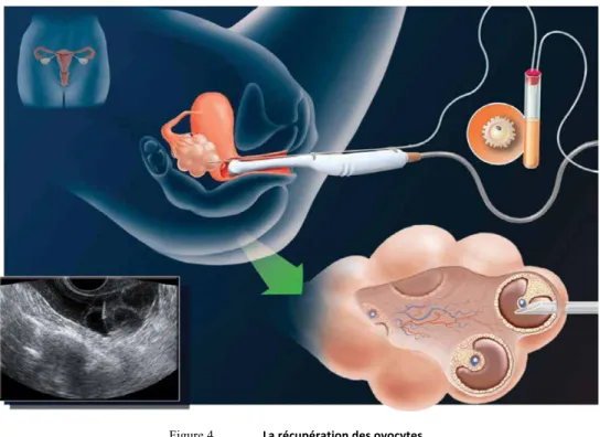 Figure 5.   Les	
  techniques	
  de	
  FIV	
  et	
  	
  d’ICSI	
   Image	
  ©	
  Dr.	
  J.	
  Herrero	
  Garcia,	
  provided	
  by	
  EMD	
  Serono,	
  Canada	
  