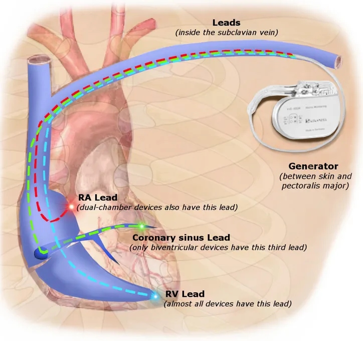 Figure   3.  Stimulateur   cardiaque   électronique.  Une   chirurgie   permet   d'implanter   le stimulateur sous la clavicule, en face d'un muscle pectoral