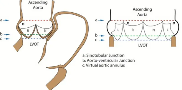 Figure 1.  Anatomie de la racine aortique. A: Jonction sinotubulaire. B: Jonction  aorto-ventriculaire