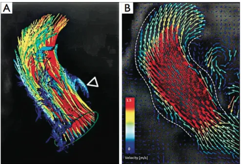 Figure 2.  Graphique de vecteur généré par résonance magnétique 4D sensible  au flux de la valve aortique tricuspide