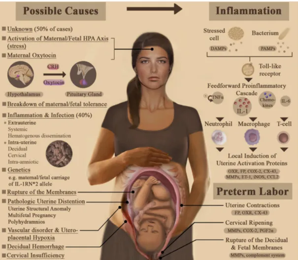 Figure  1.2 |  La naissance prématurée. Une multitude de causes de PTB, la cascade 