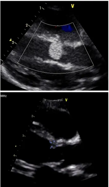 Fig. 3 Large obstructive RHM underneath the aortic valve at birth (top), then 112 days later (bottom) where a remnant tumor was measured (3.2 9 2.7 mm) and a left ventricle outflow free of obstruction