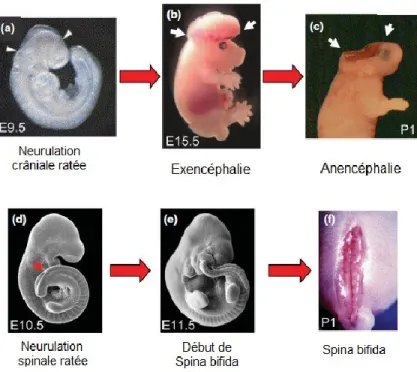 Figure 1.5  Défauts de formation du tube neural.