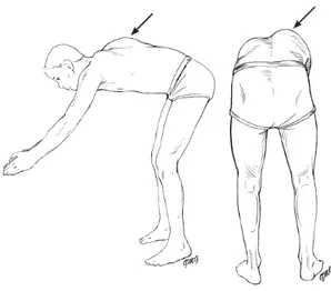 Figure 6 : Test d’Adam (flexion antérieure du tronc) 