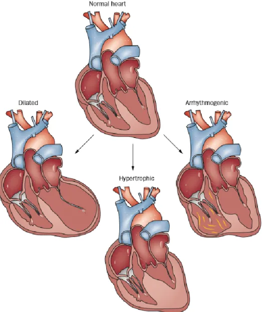 Figure 1.1. Heart morphologies of the most common types of cardiomyopathy 