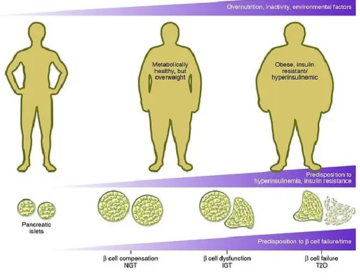 Figure 1. Développement du diabète de type 2 