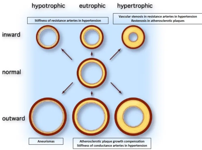 Figure 2: Types of vessel remodeling and associated pathologies