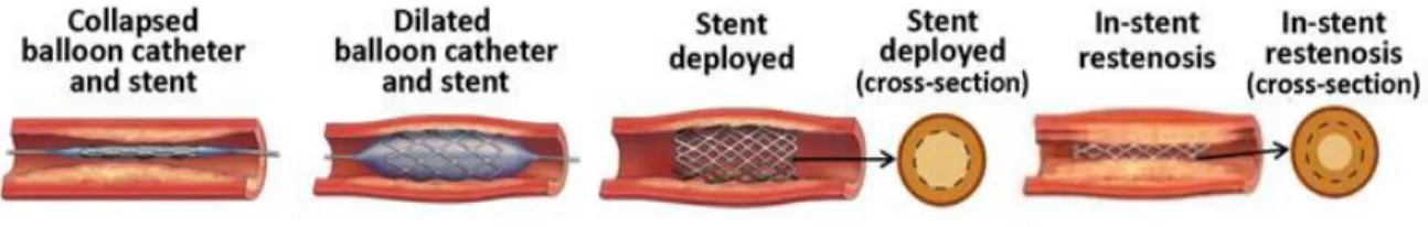 Figure 3: Inward eutrophic remodeling in restenosis  