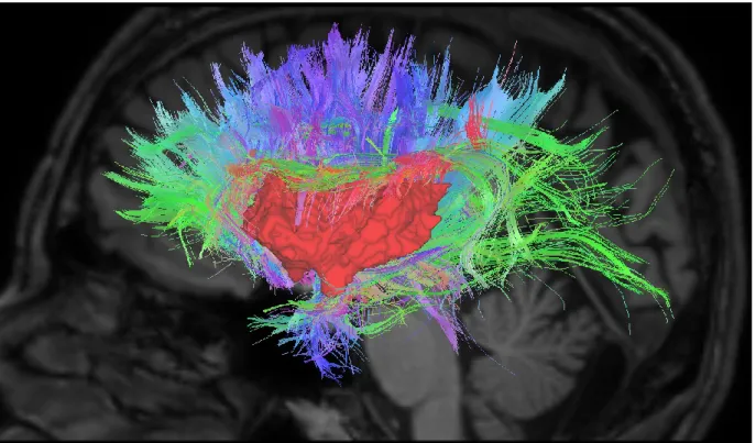 Figure 4. Streamlines from the insula to the cortex on a random subject with a threshold of  150 streamlines per voxel for illustrative purposes