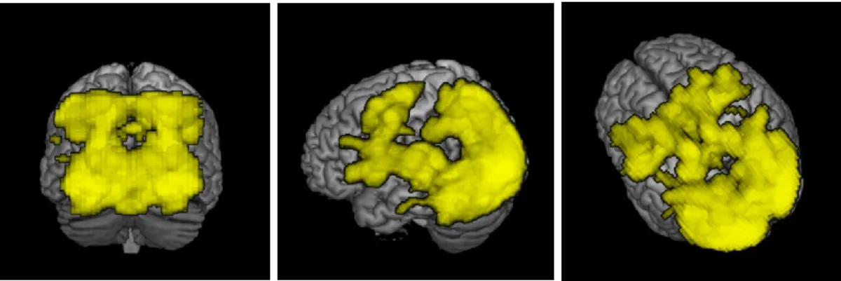 Figure 14. Régions cérébrales activées chez les sujets TSA lors du maintien   (contraste binding contrôlé – binding automatique)