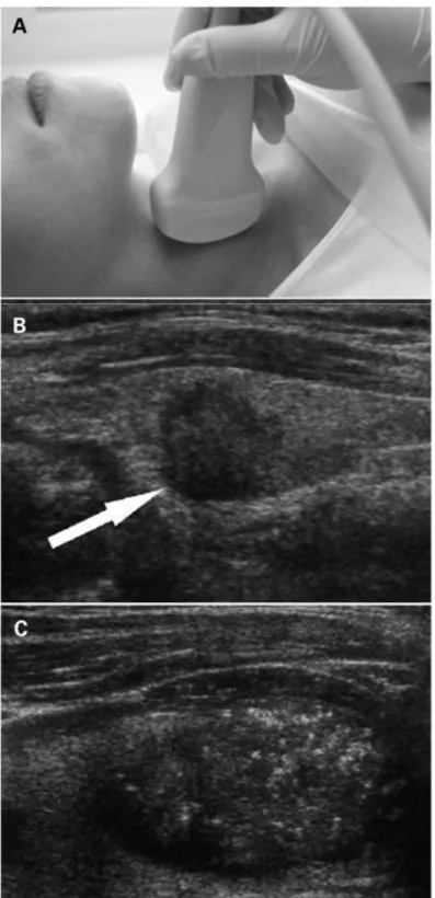 Figure 1: (A) Ultrasonography of the neck. (B) Cancerous nodule detected on ultrasound (arrow)