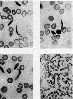 Figure 1. Blood Smear of Sickle Cell  The image was copied from J.B. Herrick (1910). 