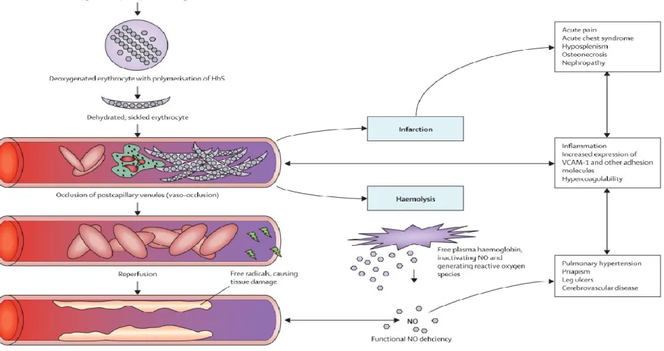 Figure 7. Pathophysiology of Sickle Cell Disease Copied from Rees DC, et al (2010)