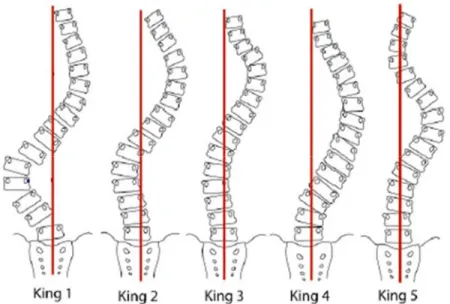 Figure 5. Divers types de courbures scoliotiques résultant de la classification de King (1983)  King 1= double courbure à lombaire prédominante; King 2= double courbure; King 3= courbure  unique thoracique droite; King 4 = courbure unique thoracolombaire; 
