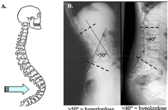 Figure 17.  A.  Lordose  lombaire ©  Georges  Dolisi  ;  B.  Hyperlordose  de  plus  de  50°  et  une  hypolordose de moins de 40° à partir de radiographies en vue sagittale