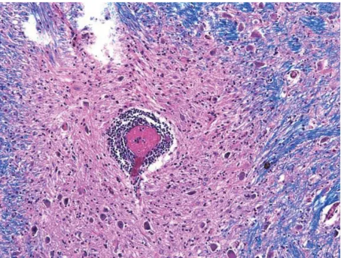 Figure 9 – Demyelinating lesion in the post-mortem brain of an MS patient. Perivascular 